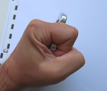 Abbildung 4: „SFG-1“ in der geschlossenen Faust, seitliche Ansicht